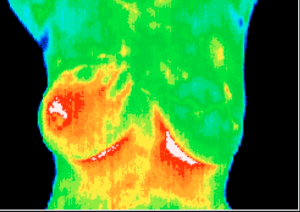 Breast Thermography Breast Thermography
