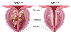 Ozone for Prostate Ozone for Prostate